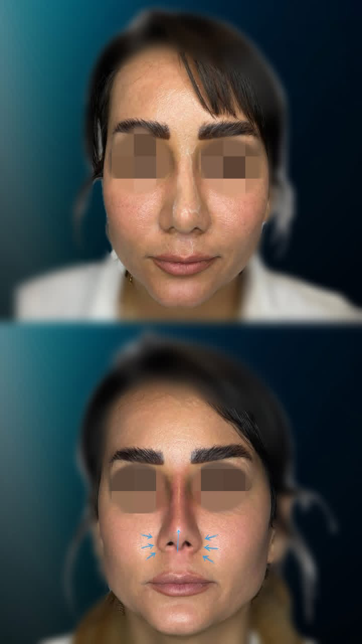 گالری آواتار بینی - تصویر 17