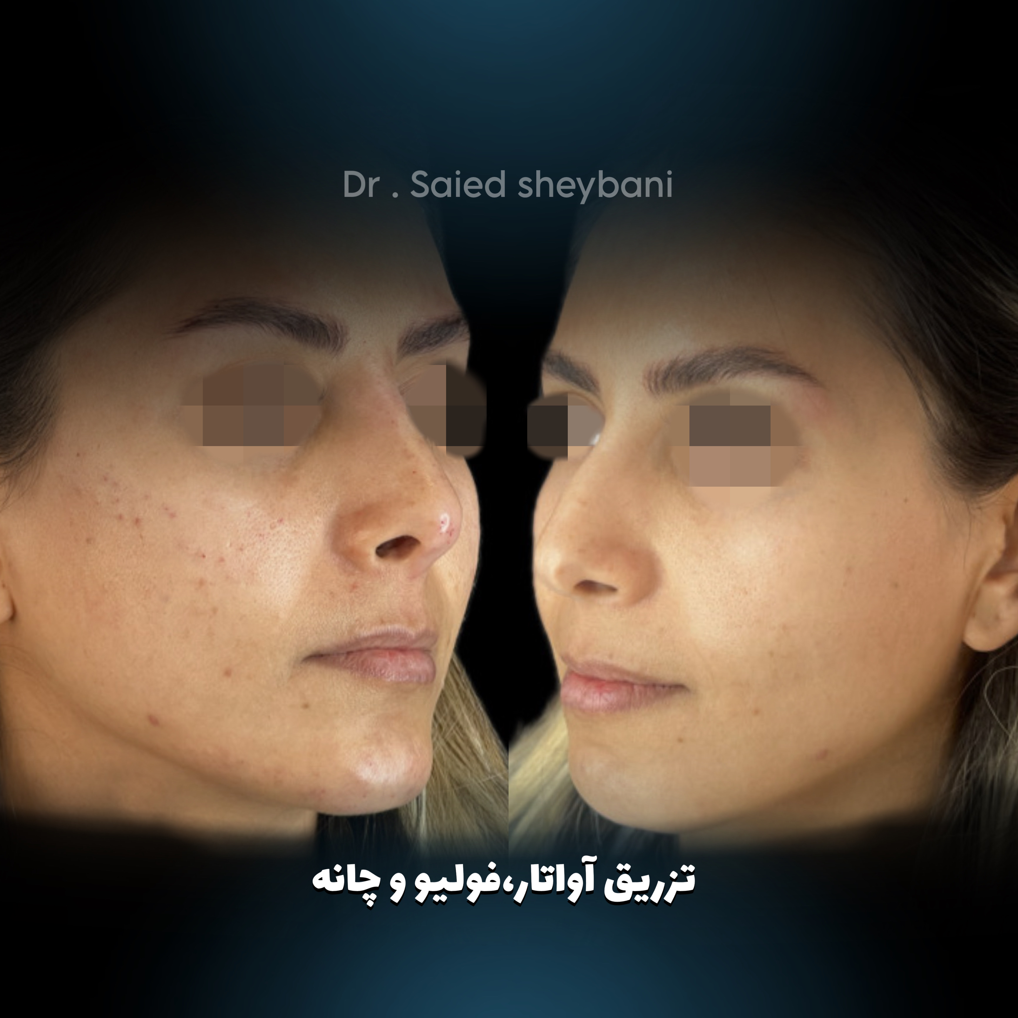 گالری آواتار بینی - تصویر 25