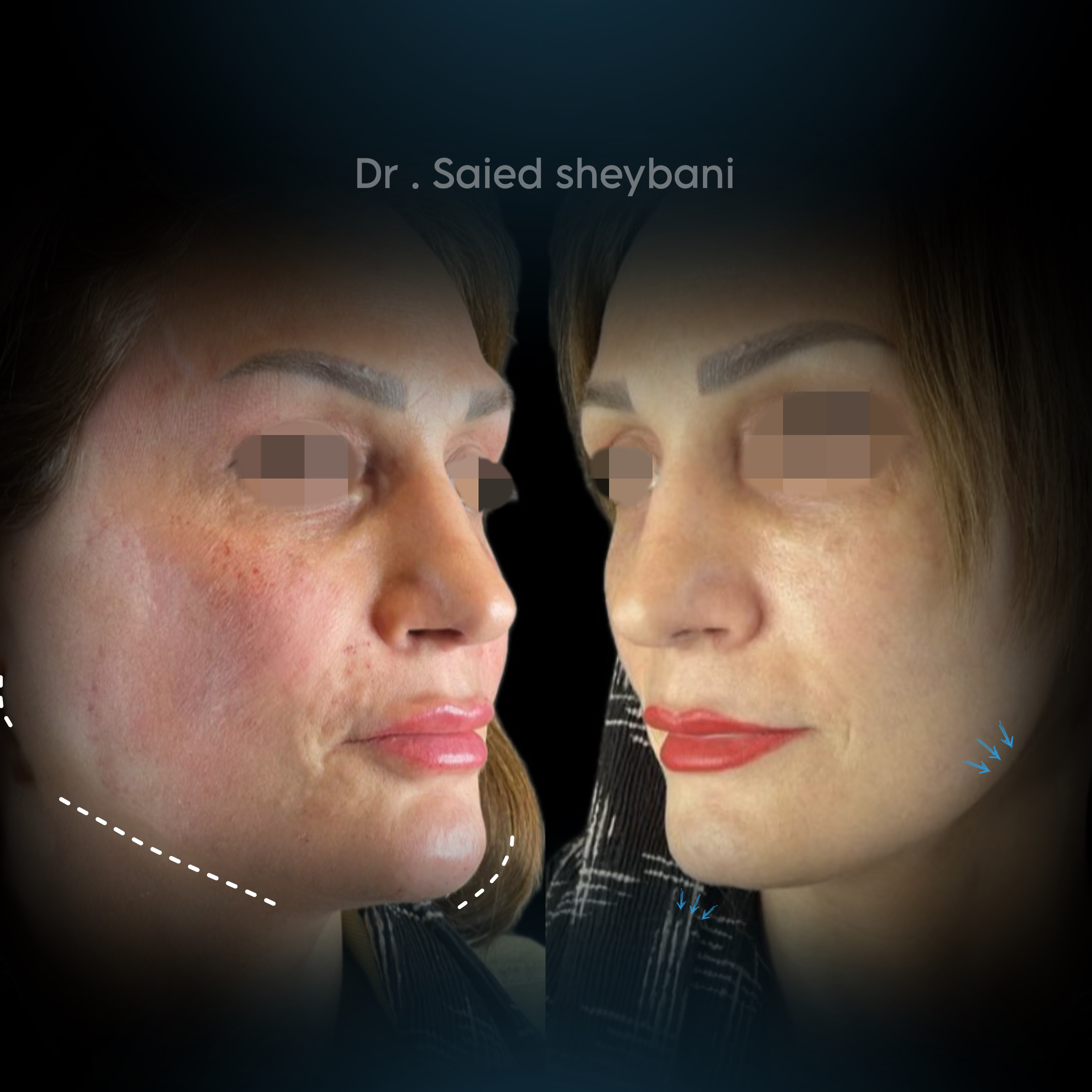 گالری Down Lift - تصویر 2