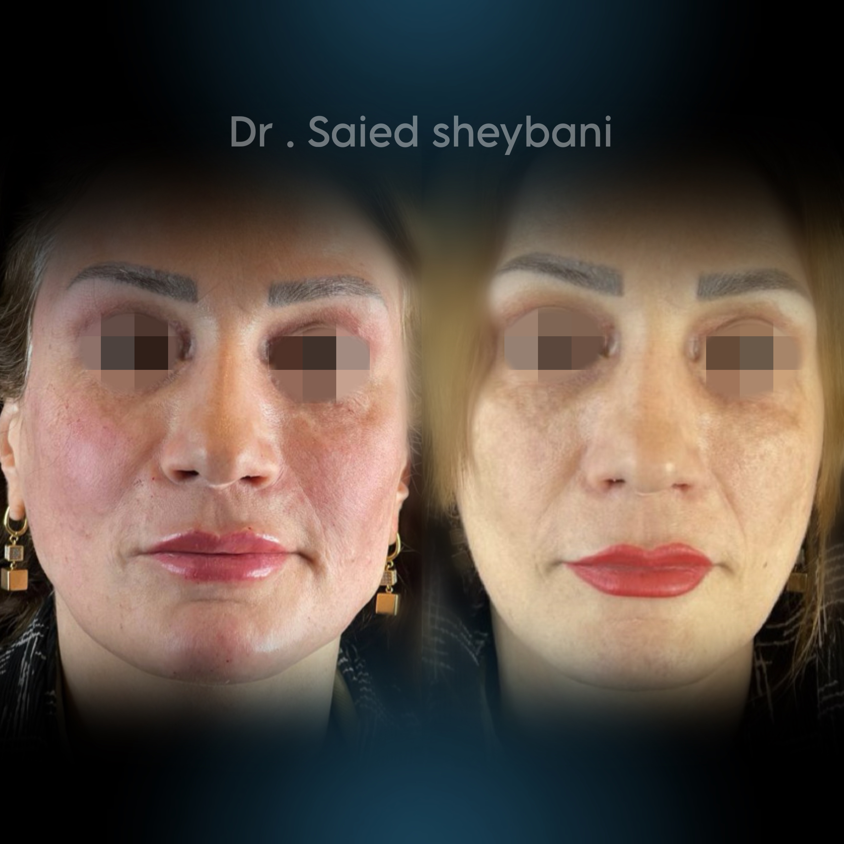 گالری Down Lift - تصویر 4